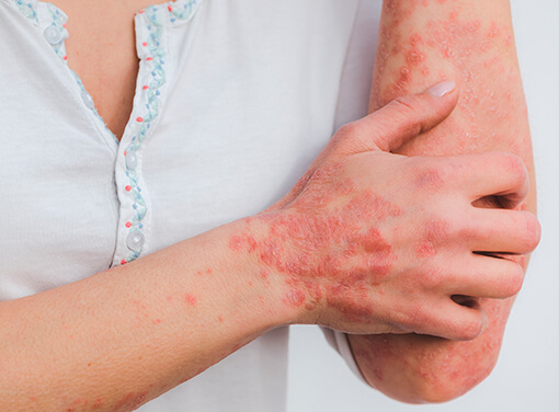 Dermatitis