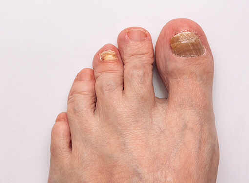 Onicomicosis (hongos en uñas)