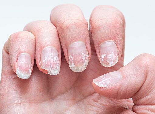 Uñas quebradizas